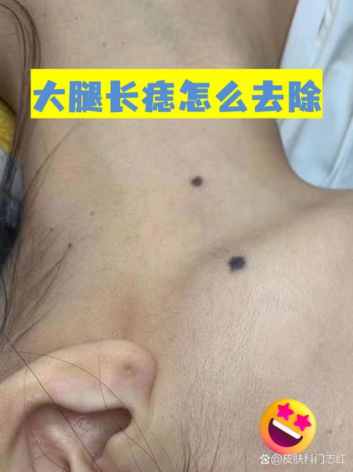 腿上的痣好不好