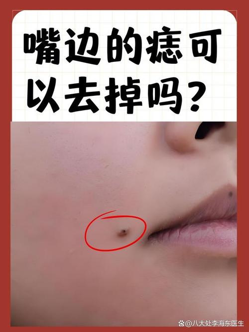 嘴唇長痣克夫嗎
