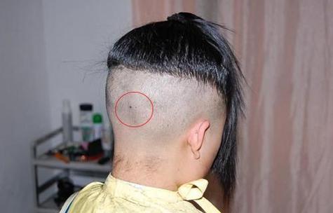 后腦勺有痣