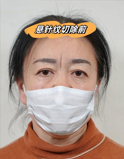 印堂懸針紋的女人是不是克夫
