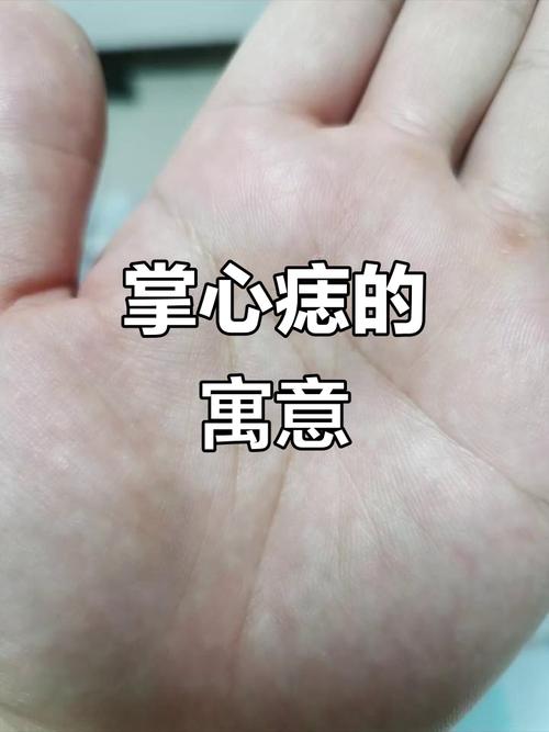 左手掌心有痣
