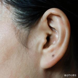 耳垂上長(zhǎng)痣