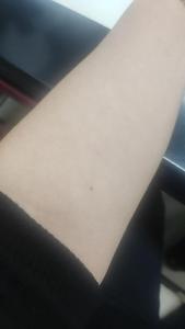 手臂內(nèi)側(cè)有痣