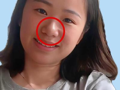 懸膽鼻長什么樣？懸膽鼻標準照片