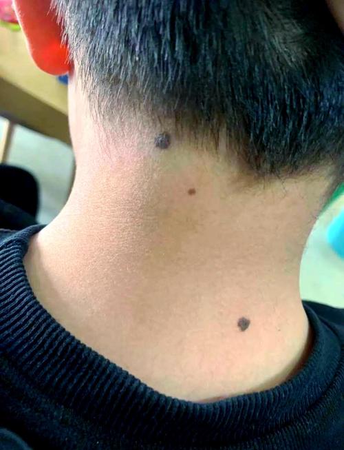 脖子有這痣窮困波折