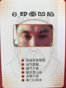 印堂上有胎記面相，代表富貴？