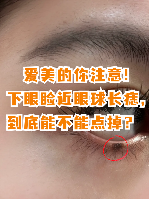 眼瞼下方有痣代表什么