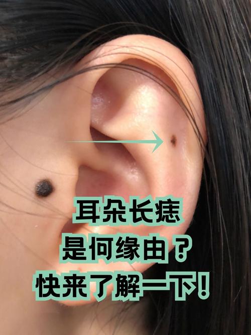 耳朵上的吉祥痣和小人痣