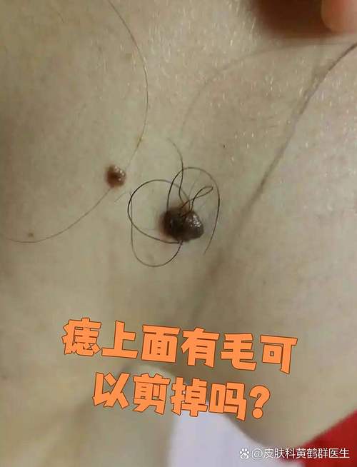 身上長痣有毛好嗎