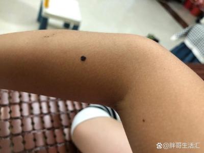 盤點手臂的活痣