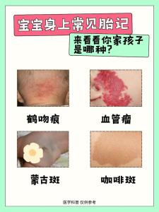 哪里的胎記大有問題