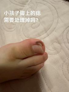 腳大拇指有痣好嗎