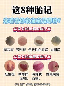 你有這些胎記嗎