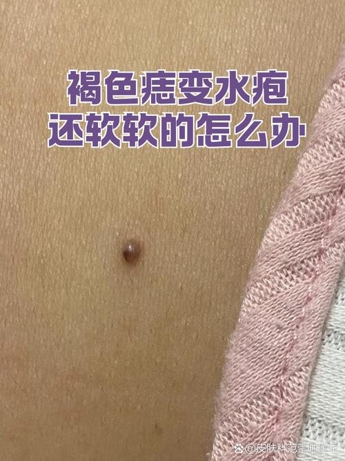 褐色的痣是吉痣