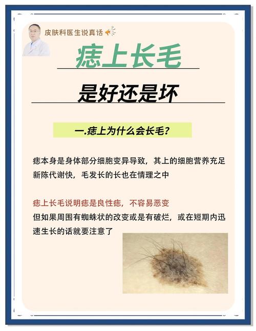 臉上的痣長(zhǎng)毛能去掉嗎
