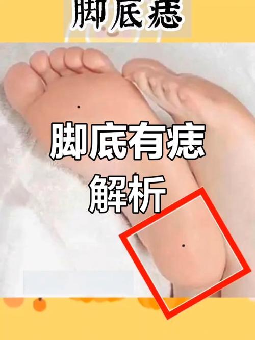 右腳底痣圖