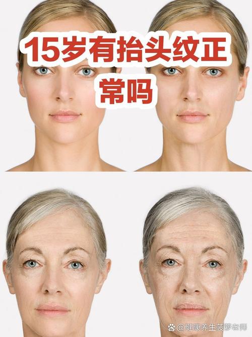 青少年有抬頭紋正常嗎 正常現象
