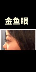 金魚眼是怎么形成的
