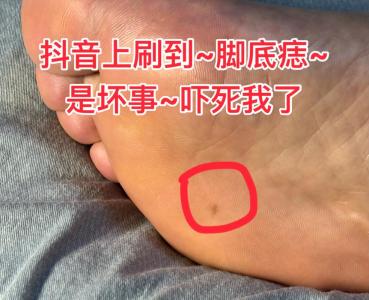 腳底有痣的男人