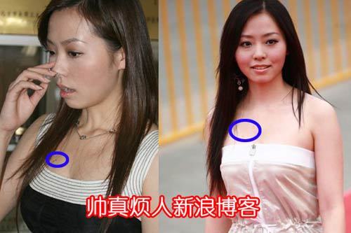 女人胸部有痣代表什么，女人胸部長痣好不好？