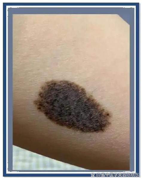 痣相分析腿上有胎記的男人命運(yùn)：一生波折，奔波勞累？