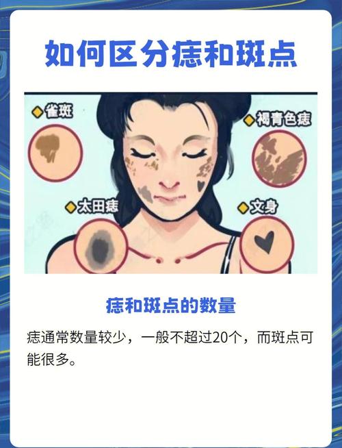 人人都會擁有的，痣和斑的區別圖解