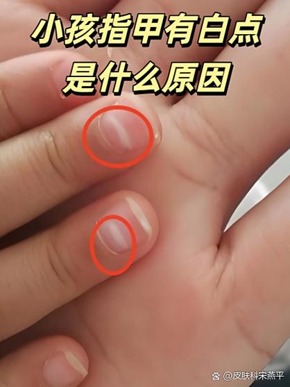 指甲上有白點是怎么回事？