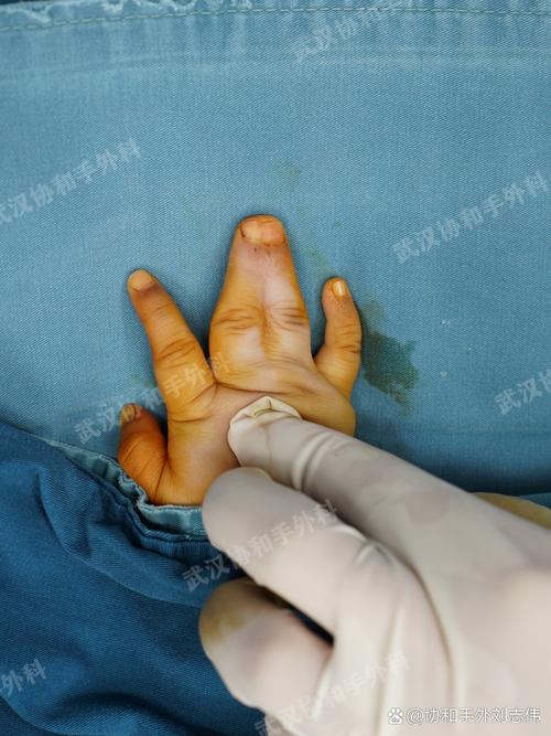 先天愚型通貫手圖片大全