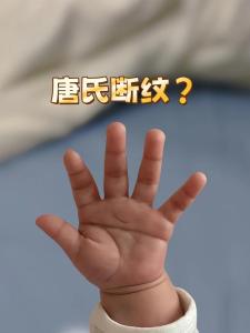 唐氏兒通貫手圖片精選