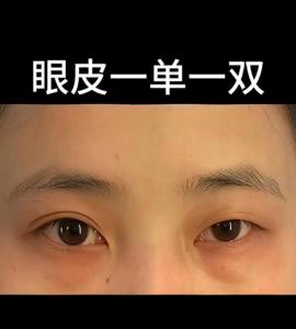 一單一雙眼皮有什么寓意