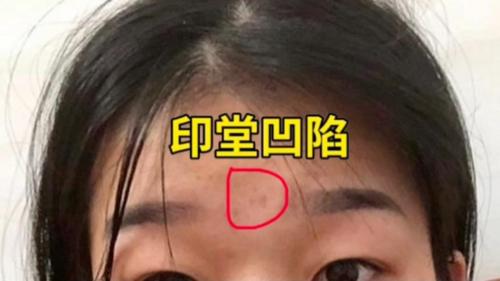 印堂凹陷的女人面相