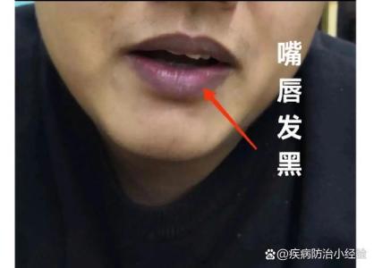 嘴唇黑的男人命