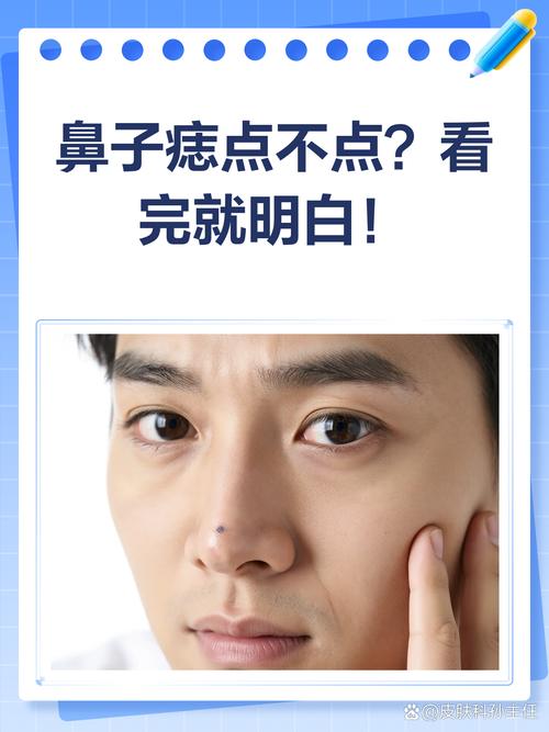 男人鼻尖長痣好不好，掙錢能力怎么樣？