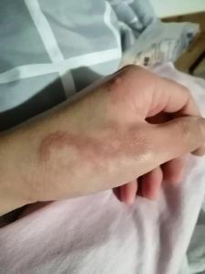 手上有胎記意味著什么，長在什么位置好？