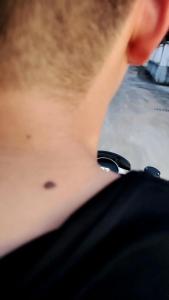 肩膀枯脊且長痣的男人主短命是真的嗎？