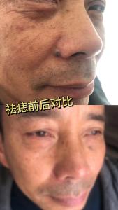男人鼻翼有痣好不好？存不住錢，沒有積蓄！