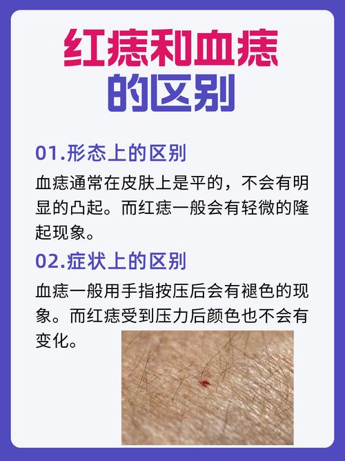 朱砂痣女主是什么意思 紅痣主吉生活穩(wěn)定