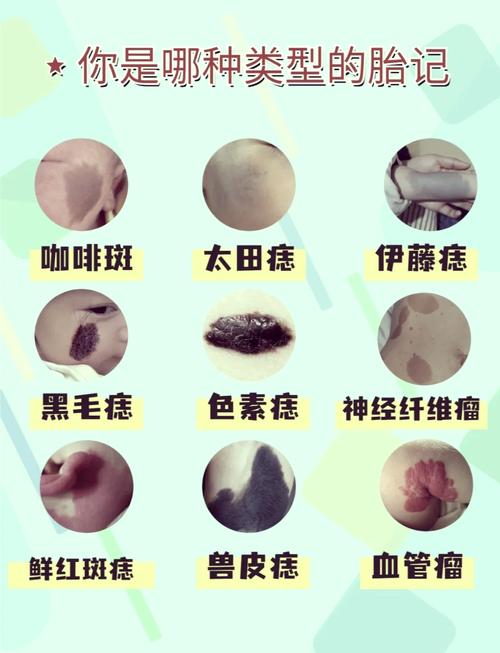 關(guān)于胎記的傳說有哪些，胎記又是怎么形成的呢？