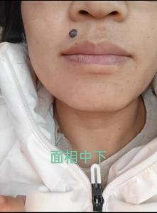 嘴唇上方有痣,嘴唇上方中間長一顆黑痣好不好?