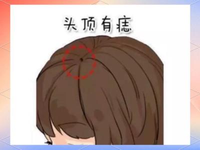 大富大貴的暗藏痣 頭頂痣為福慧痣