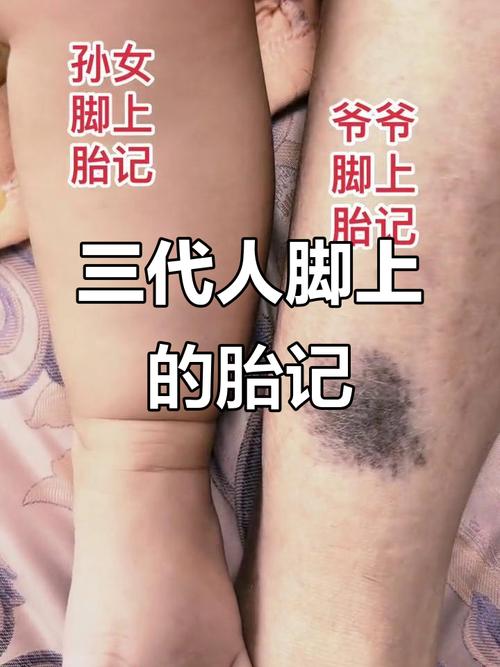 腳上長胎記代表什么，什么地方的胎記寓意好？