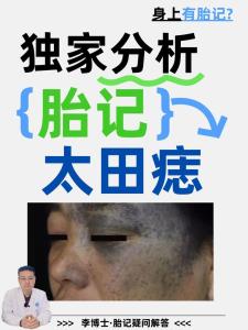 胎記上長痣代表什么意思？要結合其位置來看！