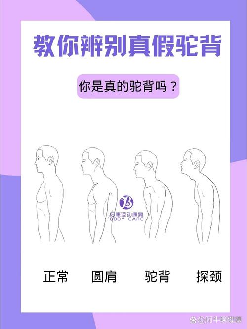 人駝背和龜背區(qū)別圖解 一生命運(yùn)好不好
