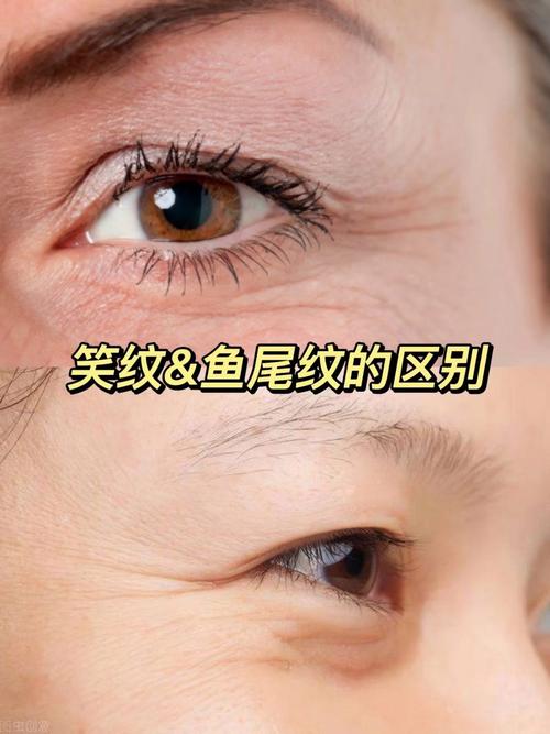 魚尾紋和陰騭紋的區別