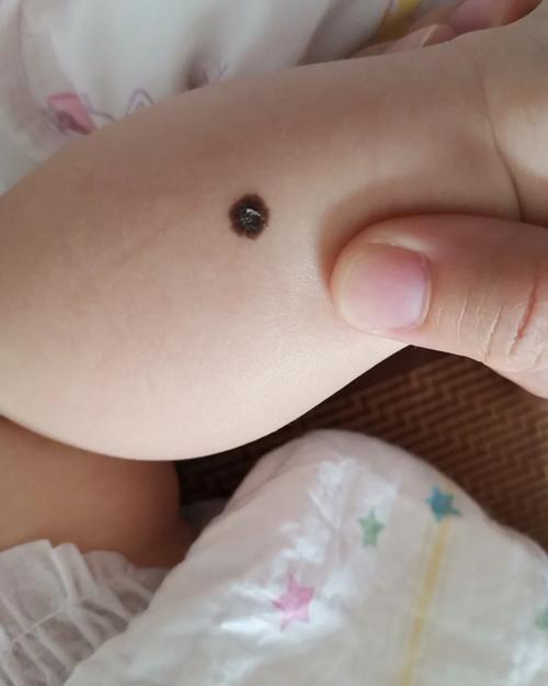 孩子身上什么痣最有出息