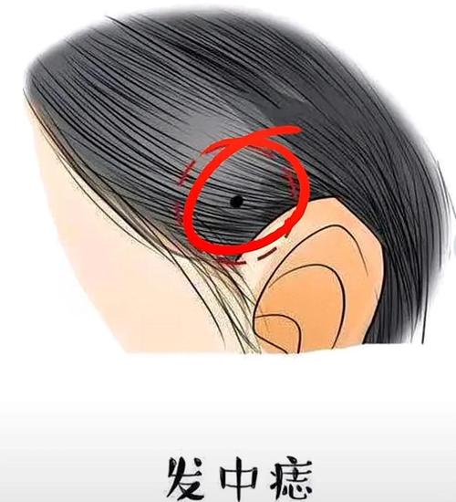 頭發中有痣的人，真的是天生的富貴命嗎？