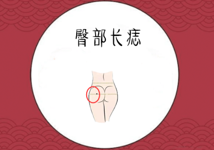 女人左邊臀部長(zhǎng)痣好不好，代表什么意思？