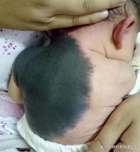 小男孩后背有痣好不好 聰明好學福氣多多