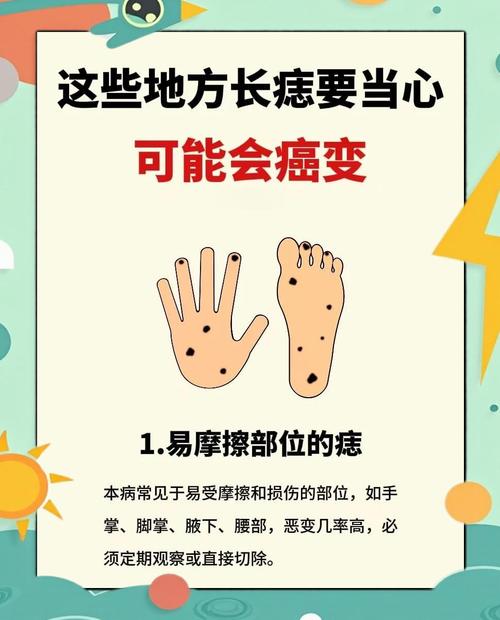 這四處痣會給你帶來大麻煩！需注意！