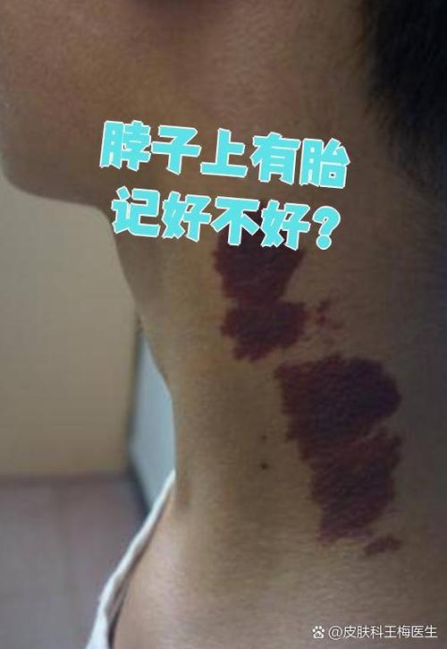 有胎記好不好 胎記長在哪里最好